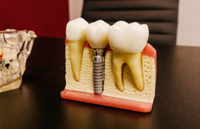 Dental Implant Healing